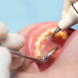 dental treatment in dentistry - 3d dental