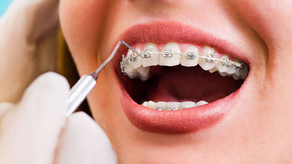thumbnail tratament ortodontic - 3d dental